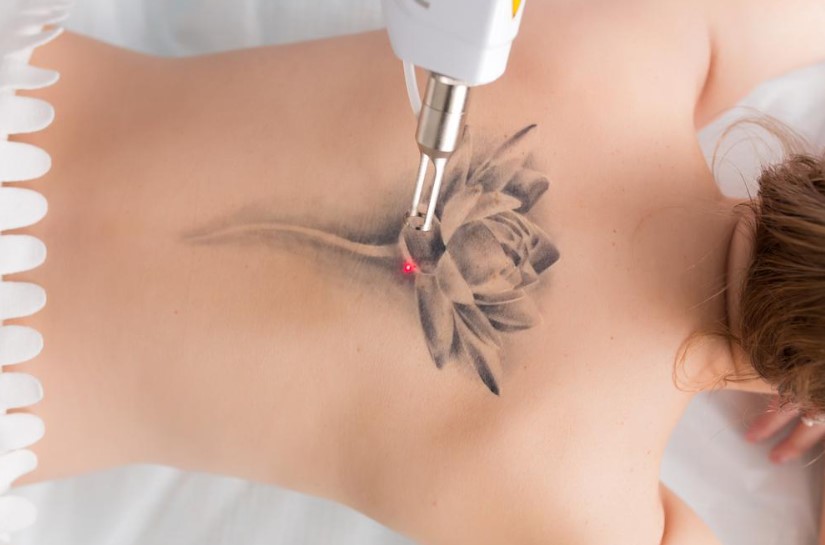 7 Things You Should Know Before Getting a Tattoo Laser Removal