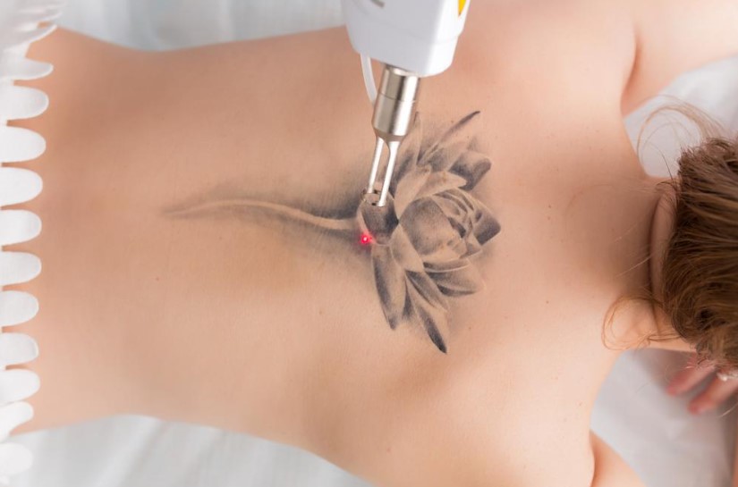 7 Things You Should Know Before Getting a Tattoo Laser Removal 7 Things You Should Know Before Getting a Tattoo Laser Removal